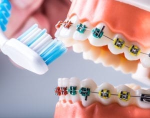 brushing your teeth with braces in Flower Mound, Texas