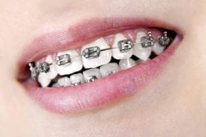 affordable traditional metal braces in Flower Mound Texas