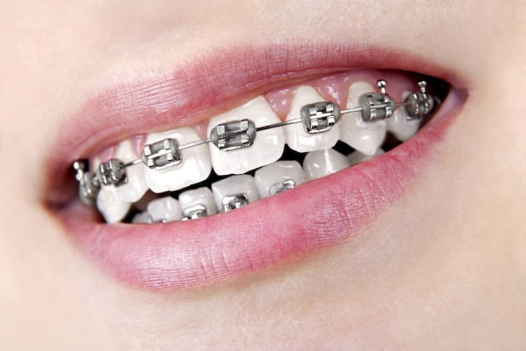 traditional metal braces in Flower Mound, TX