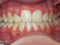 Orthodontics treatments in Flower Mound Texas