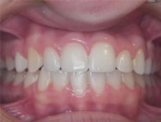 Orthodontics treatments in Flower Mound Texas