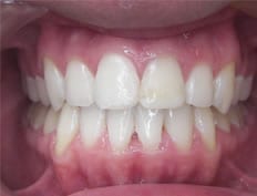 Orthodontics treatments in Flower Mound Texas