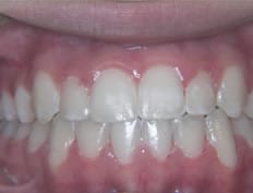 Orthodontics treatments in Flower Mound Texas