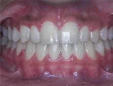 Orthodontics treatments in Flower Mound Texas