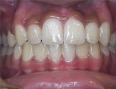 Orthodontics treatments in Flower Mound Texas