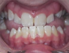 Orthodontics treatments in Flower Mound Texas