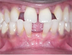 Orthodontics treatments in Flower Mound Texas