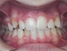 Orthodontics treatments in Flower Mound Texas