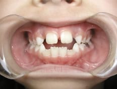 Orthodontics treatments in Flower Mound Texas