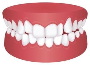 The Different Types of Bite Problems in Flower Mound, Texas