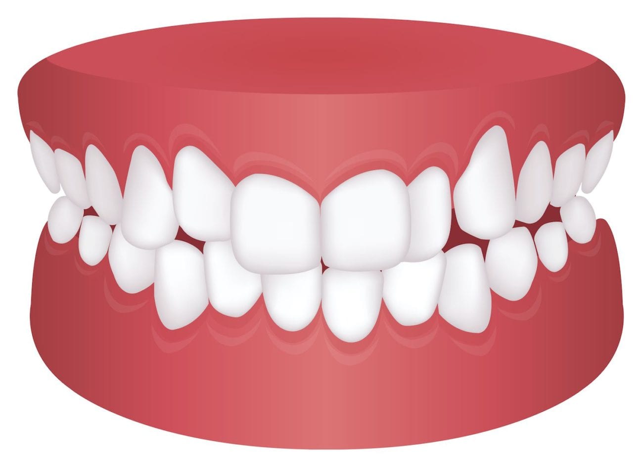 The Different Types of Bite Problems