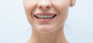 deep bite orthodontic treatment in Flower Mound Texas