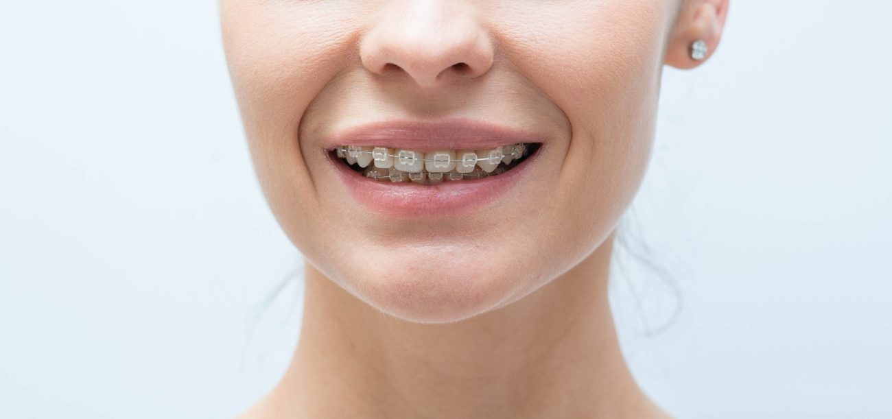 Deep Bite Invisalign