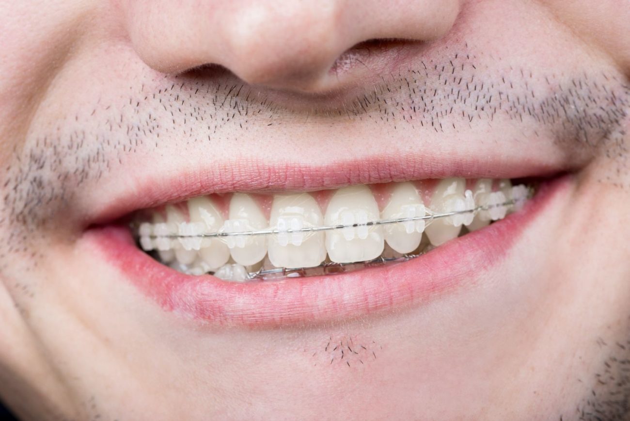 straighten crooked teeth in Flower Mound Texas