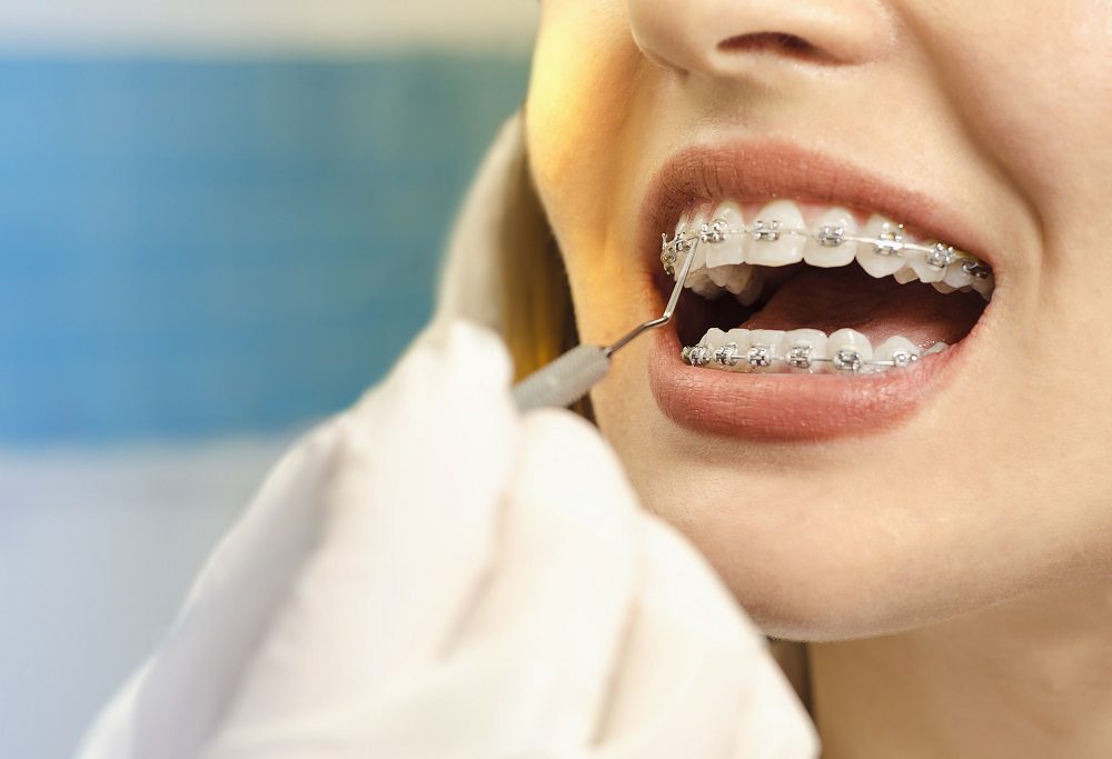 dental work with braces on teeth
