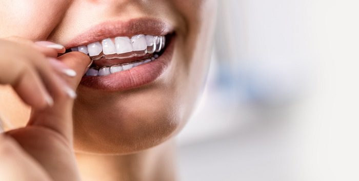 Compliance Tips for Invisalign