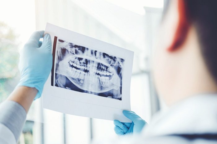 Wisdom Teeth and Dental Alignment