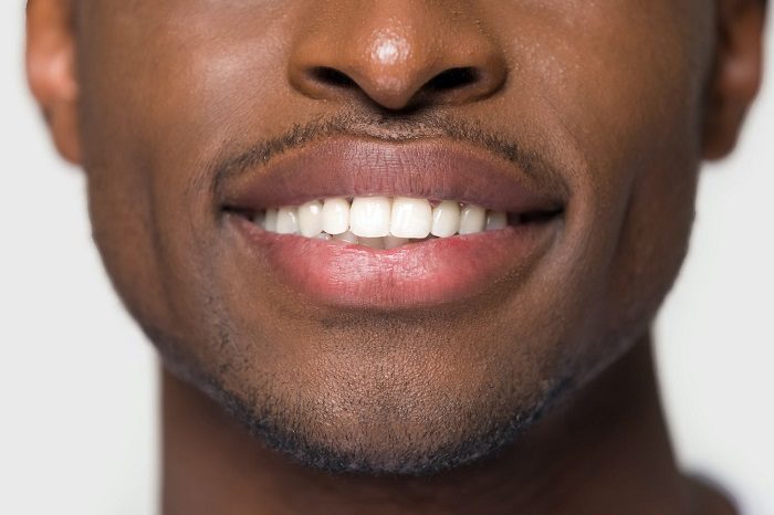What to Expect from Smile Widening